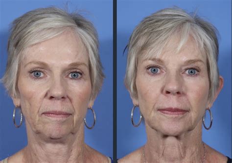 Liquid Facelift | Before & After Photos | Dr. Timothy Minton