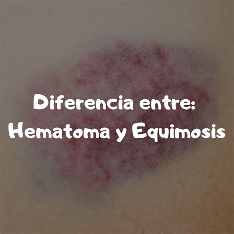 DIFERENCIA ENTRE HEMATOMA Y EQUIMOSIS