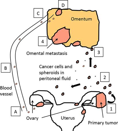 Ovarian Cancer - Supratik