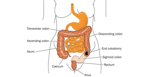 Colostomy surgery for IBD | IBDrelief