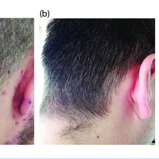 Case 1: At presentation (a); after 4 weeks treatment with calcipotriol ...