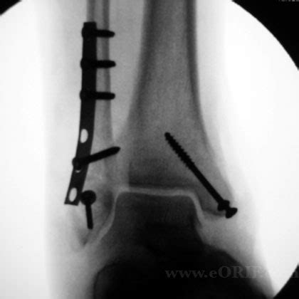 Ankle Fracture ORIF 27814 | eORIF