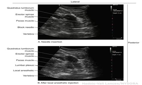 Paravertebral Block Ultrasound