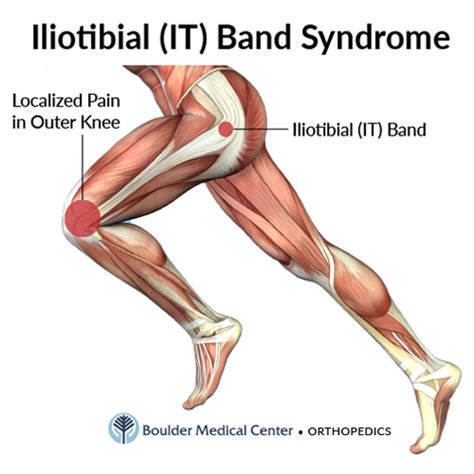 Knee Pain Could Indicate IT Band Syndrome