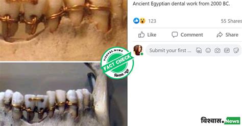 Fact Check: Viral post claiming to show ancient Egyptian dental work from 2000 BC is misleading ...