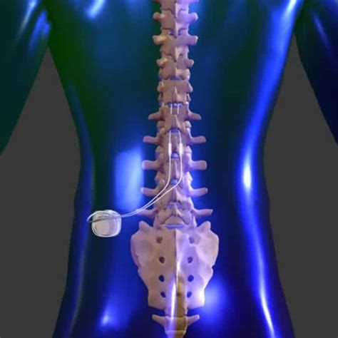 Spinal Cord Stimulation - Thrive Pain Management