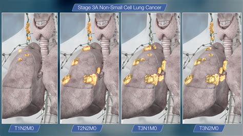 Understanding Stage Three Lung Cancer - Insurance Business