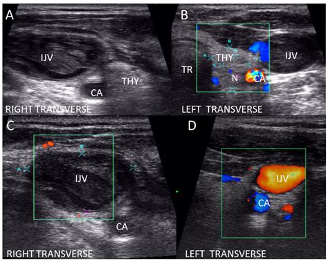 Abnormal jugular vein detected during thyroid ultrasound