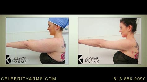 Lipedema Surgery | Celebrity Arms™ Liposuction | High-Definition ...