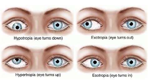 Paediatrics - Children’s Eye Conditions – Envision Eye Centre