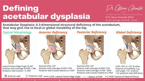 Acetabular Dysplasia: Development and Prevention | Find out more