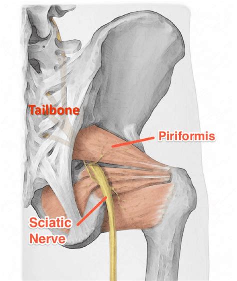 Piriformis syndrome causes and treatment with 6 exercises