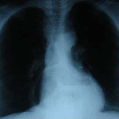 Chest x-ray showing air bubbles in the left chest. | Download High ...