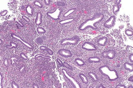 Disordered proliferative endometrium - Libre Pathology