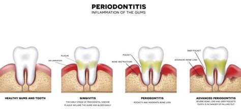 Stages of Gum Disease (Periodontitis): Maritza O Jenkins, DMD: General Dentist