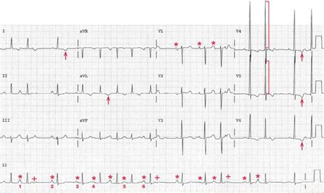 Multifocal Atrial Tachycardia Strip