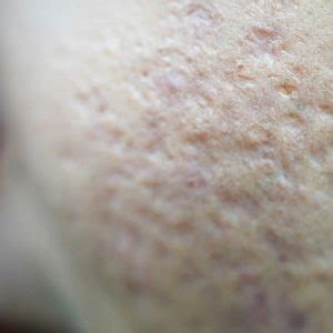 Acne Scar Removal : Treatment Options, Price and Reviews