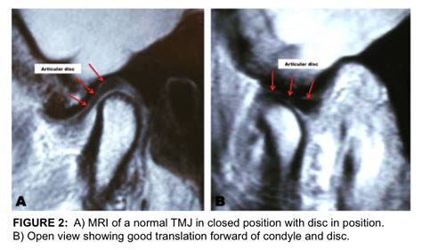 Total Temporomandibular Joint (TMJ) Replacement