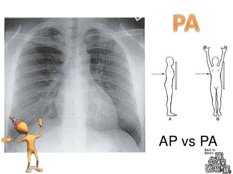 Chest Radiograph for Interns