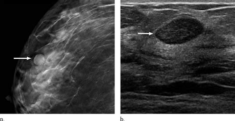 Six-month follow-up appropriate for BI-RADS 3 findings on mammography