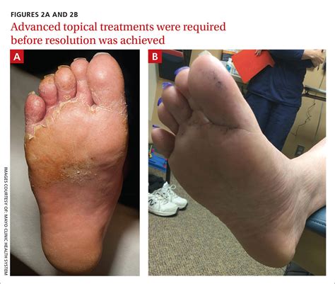 Malodorous discharge, redness, and crusting of the feet | MDedge Family ...