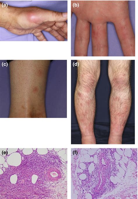 Guidelines for the treatment of skin and mucosal lesions in Behçet's disease: A secondary ...