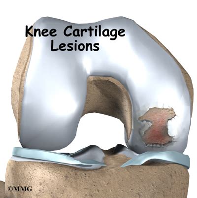 Articular Cartilage Problems of the Knee – James Seeds, MD, Orthopedic ...