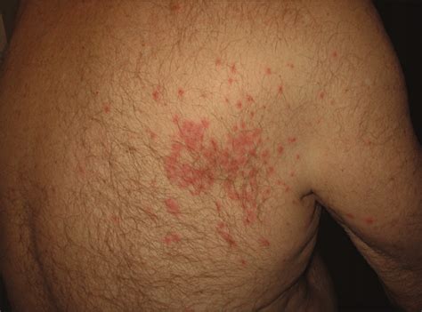 Erythematous Papular Rash on the Upper Back Area—Quiz Case ...