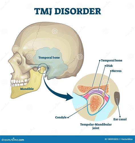 TMJ Disorder Vector Illustration. Labeled Jaw Condition Educational Scheme Stock Vector ...