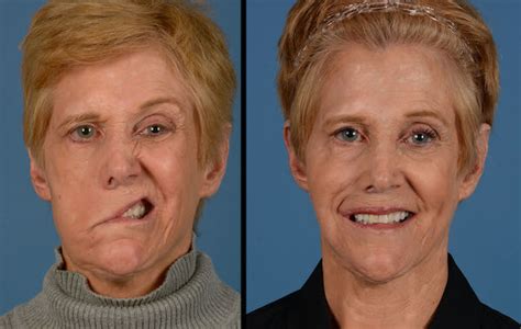 How Susan got her smile back: A journey overcoming facial paralysis | Plastic Surgery | UT ...