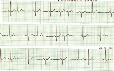 Wandering Atrial Pacemaker