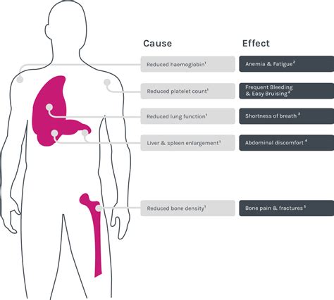 What are the main signs and symptoms of Gaucher disease? - Gauchersymptoms.me