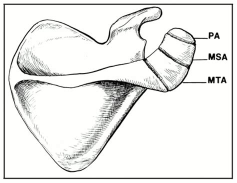 The Treatment of Symptomatic Os Acromiale* : JBJS