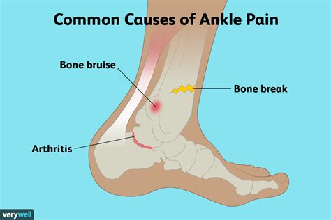 Ankle Pain 11 Reasons To Take It Seriously Best Health