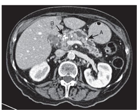 Chronic Pancreatitis