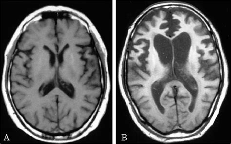 dementia typesAlzheimer's front temporal vascular dementia posterior ...