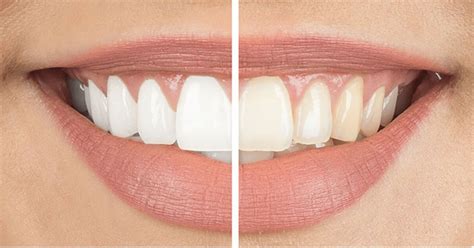 Tips for natural teeth whitening - Samples Beauty