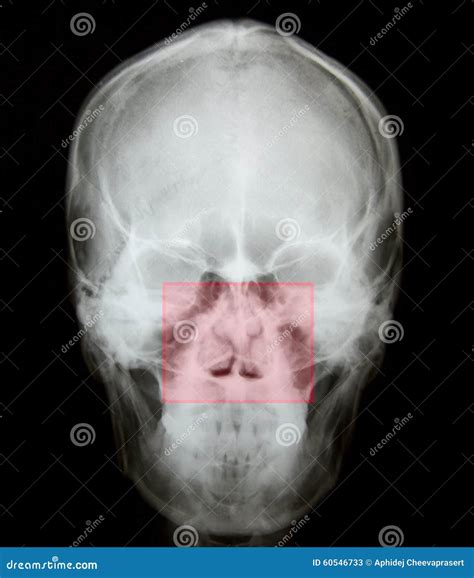 X Ray Of Nasal Bone Fracture Stock Image | CartoonDealer.com #60546733