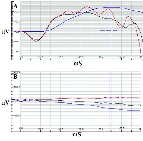 Electroretinography results of case 1 with normal traces of rod (blue ...