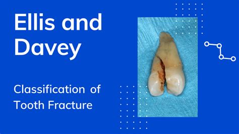 Ellis and Davey Classification (1970) - Dental Pockets Blog