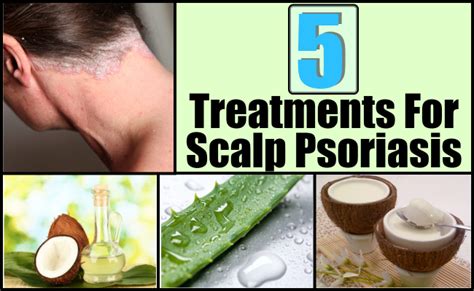 TOP 5 TREATMENTS FOR SCALP PSORIASIS ~ Mzizi Mkavu