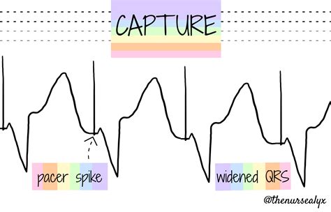 Transcutaneous Pacing for Nurses – CriticalCareNow