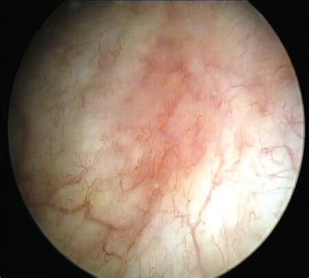 What Is A Cystoscopy And Is It Helpful For Recurrent UTI?