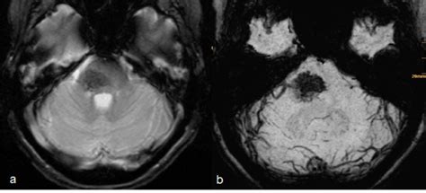 Capillary telangiectasia of the brainstem: MR features