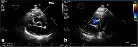 Echocardiography. a Showing the Sinus of Valsalva aneurysm (SVA ...