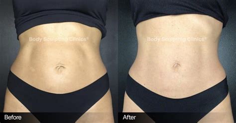 Before and After | Body Sculpting Clinic