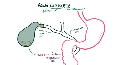 Acute cholecystitis: Video, Anatomy & Definition | Osmosis