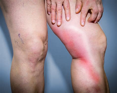 Superficial Phlebitis & Thrombophlebitis - Causes, Diagnosis, TreatmenT