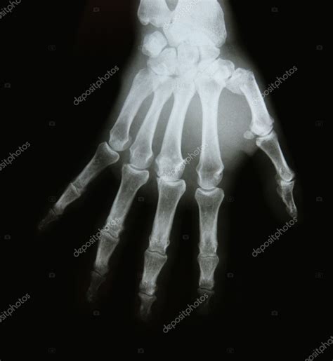 X-ray image of the bones of arm — Stock Photo © AlikeYou #9842223