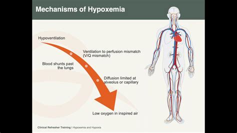 Hypoxemia & Hypoxia - YouTube